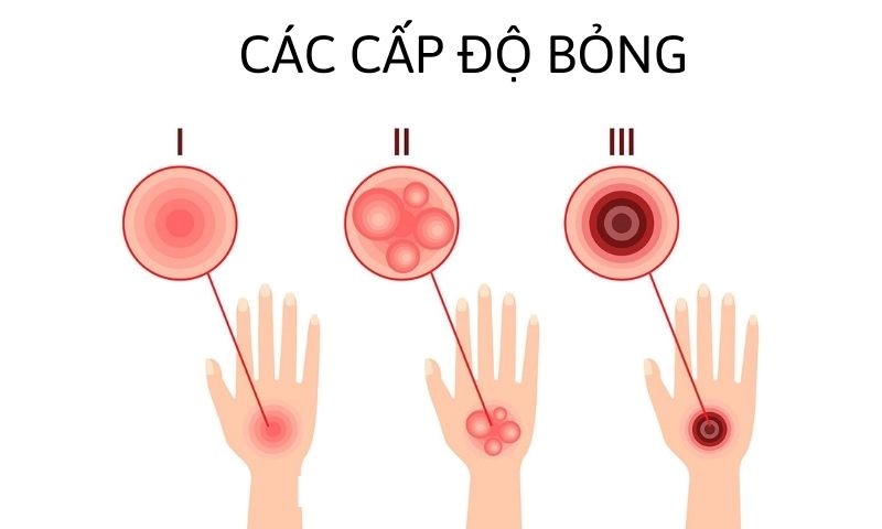 các cấp độ phỏng